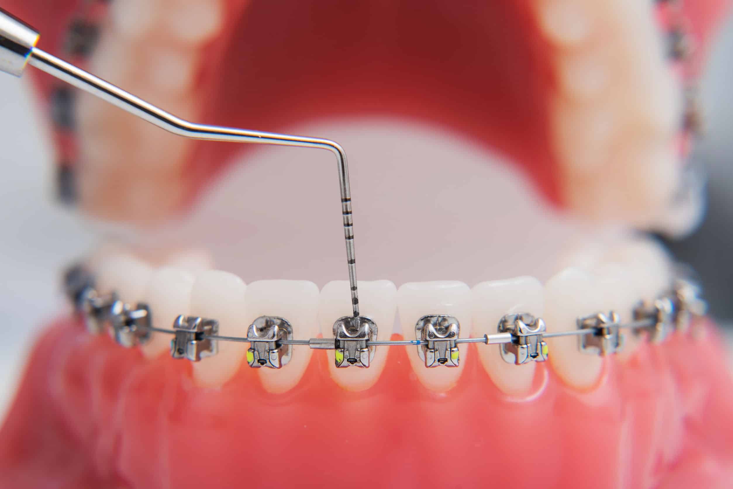 What Is Orthodontics? Why Should You Have Braces? - Floorproof