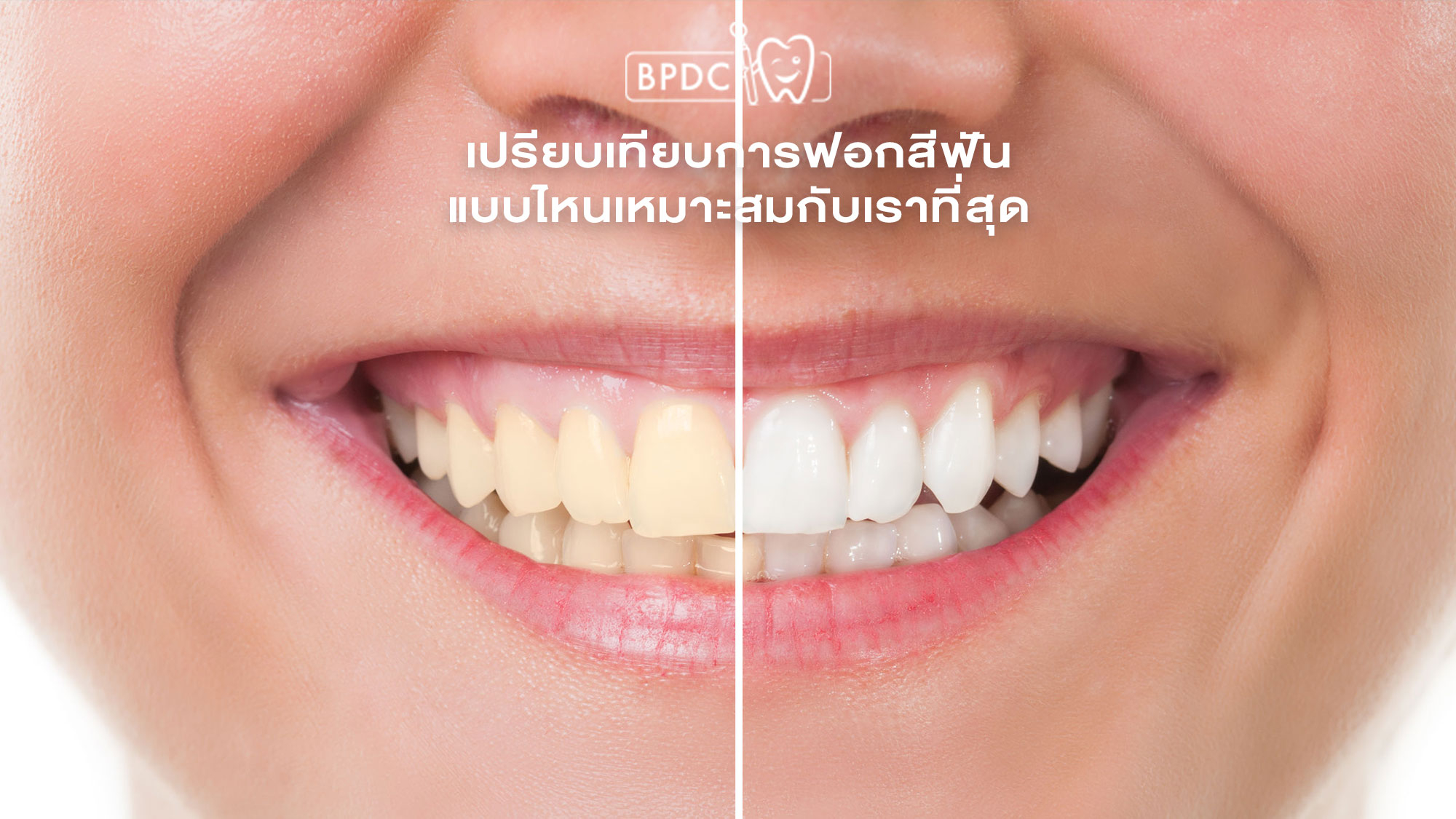 เปรียบเทียบการฟอกสีฟัน แบบไหนเหมาะสมกับเราที่สุด