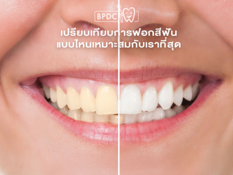 เปรียบเทียบการฟอกสีฟัน แบบไหนเหมาะสมกับเราที่สุด