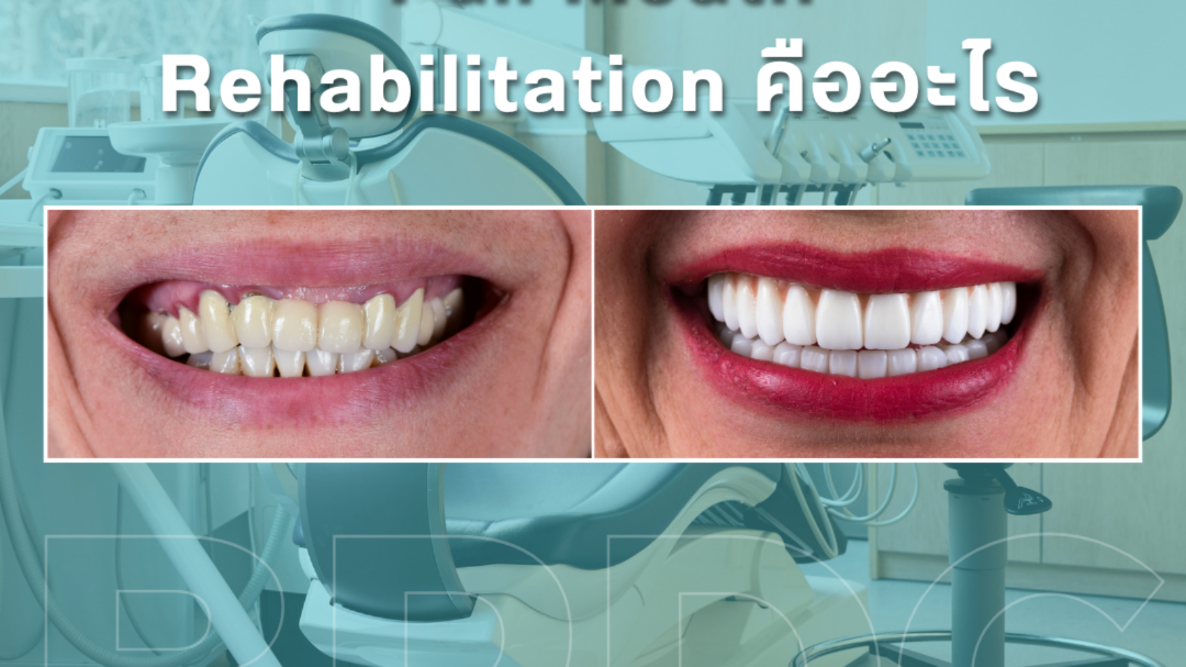 Full Mouth Rehabilitation คืออะไร