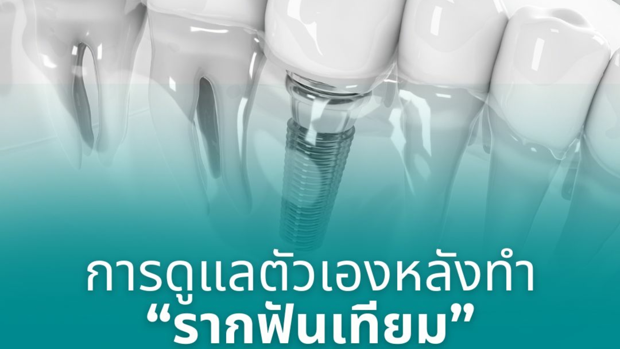 การดูแลตัวเองหลังทำ “รากฟันเทียม”