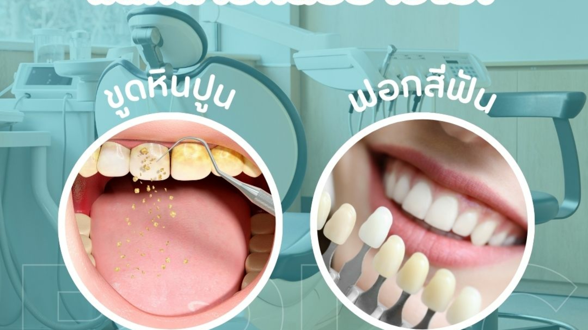 ขูดหินปูน ฟอกสีฟัน แตกต่างกันอย่างไร