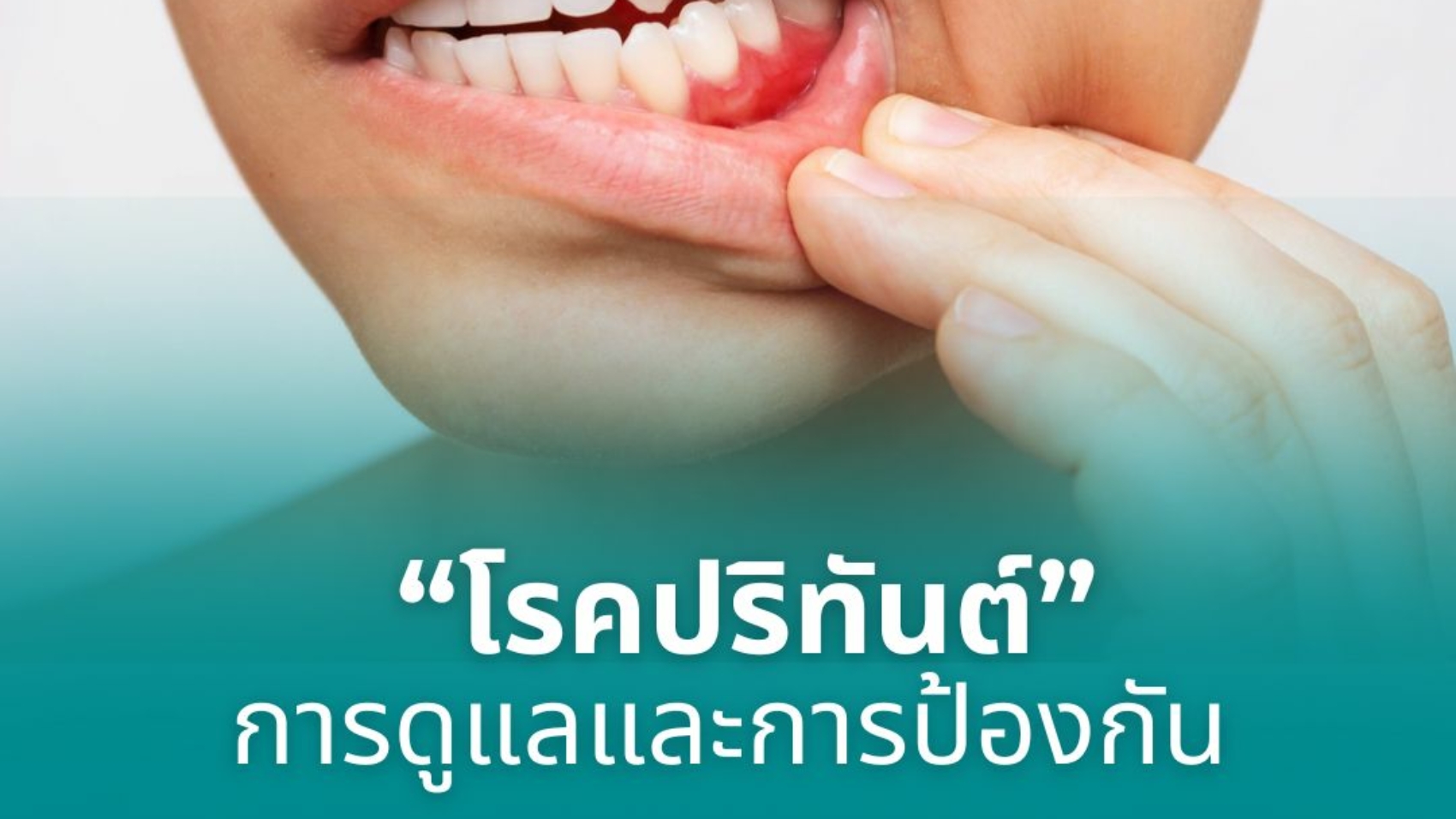 โรคปริทันต์การดูแลและการป้องกัน