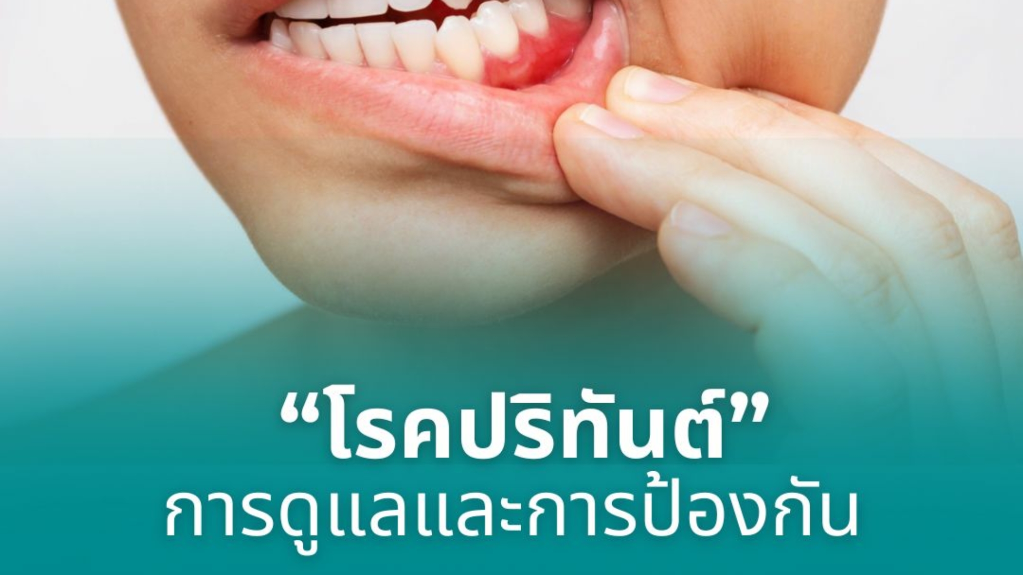 โรคปริทันต์การดูแลและการป้องกัน