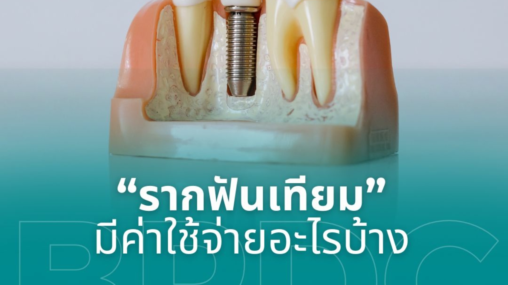 รากฟันเทียม มีค่าใช้จ่ายอะไรบ้าง