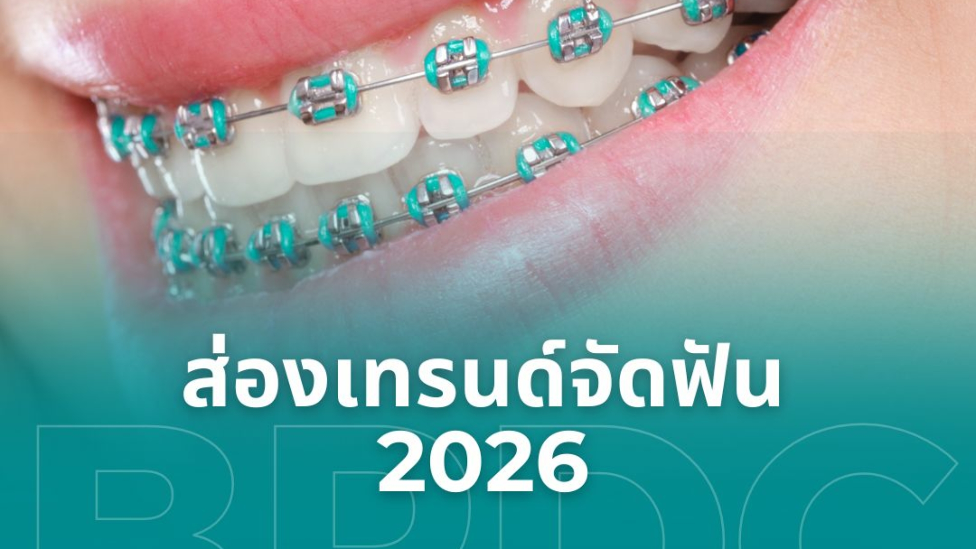 ส่องเทรนด์จัดฟัน 2026