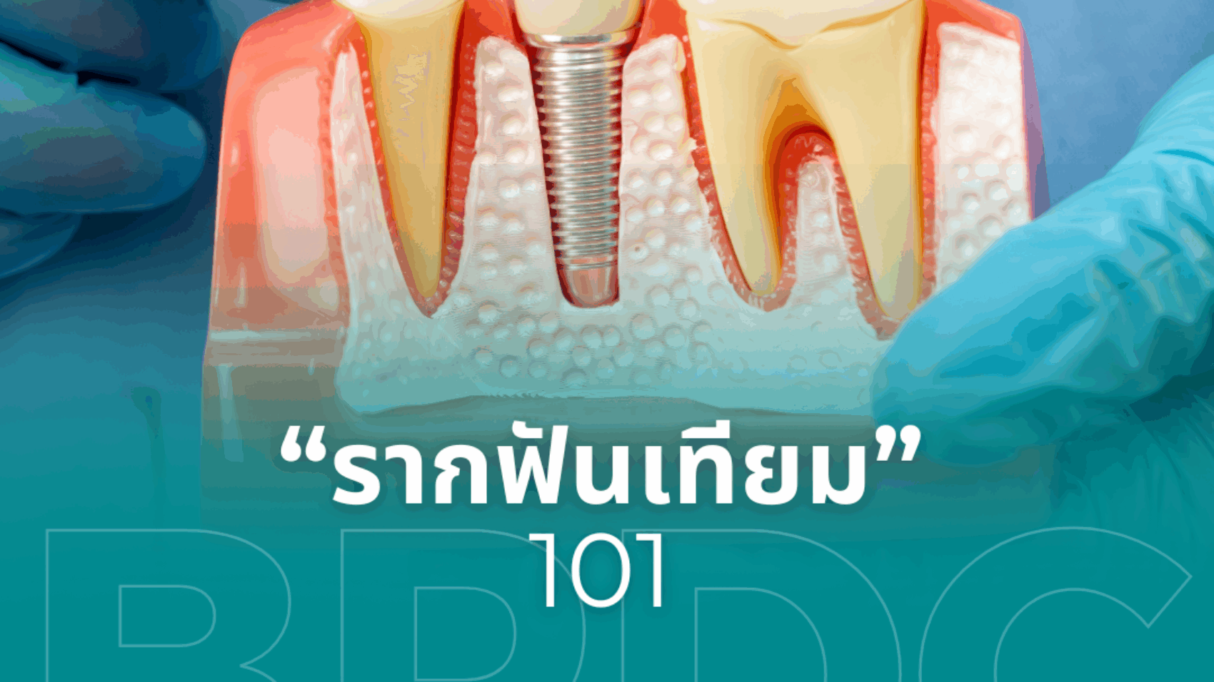 รากฟันเทียม 101