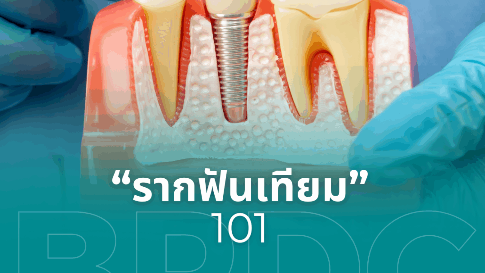 รากฟันเทียม 101