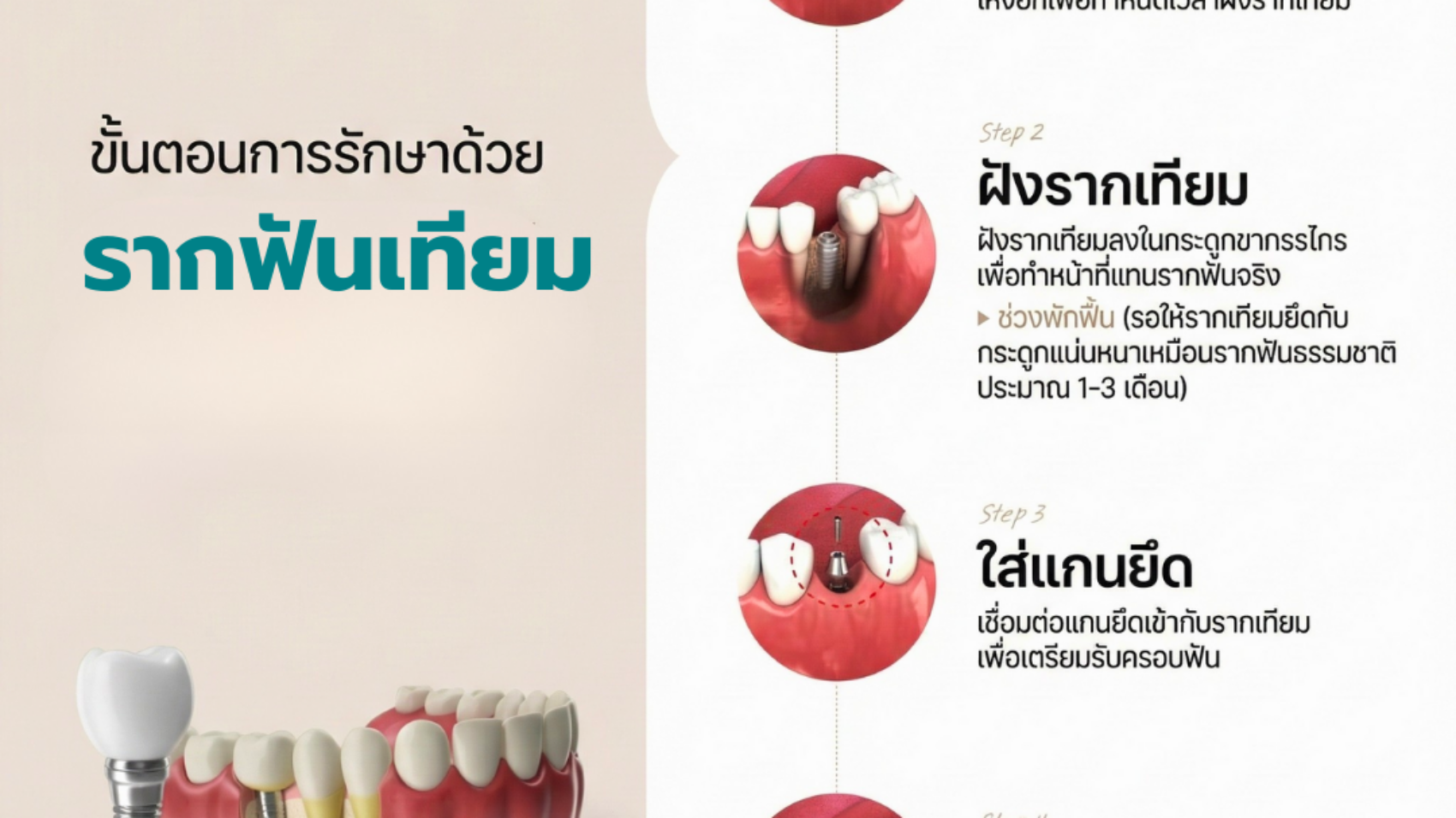 ขั้นตอนการรักษาด้วยรากฟันเทียม