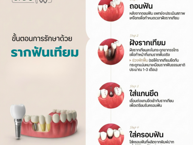 ขั้นตอนการรักษาด้วยรากฟันเทียม