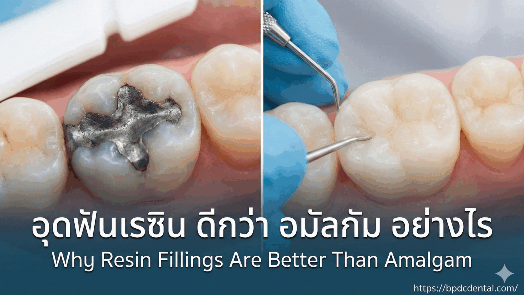 อุดฟันเรซินดีกว่าอมัลกัมอย่างไร