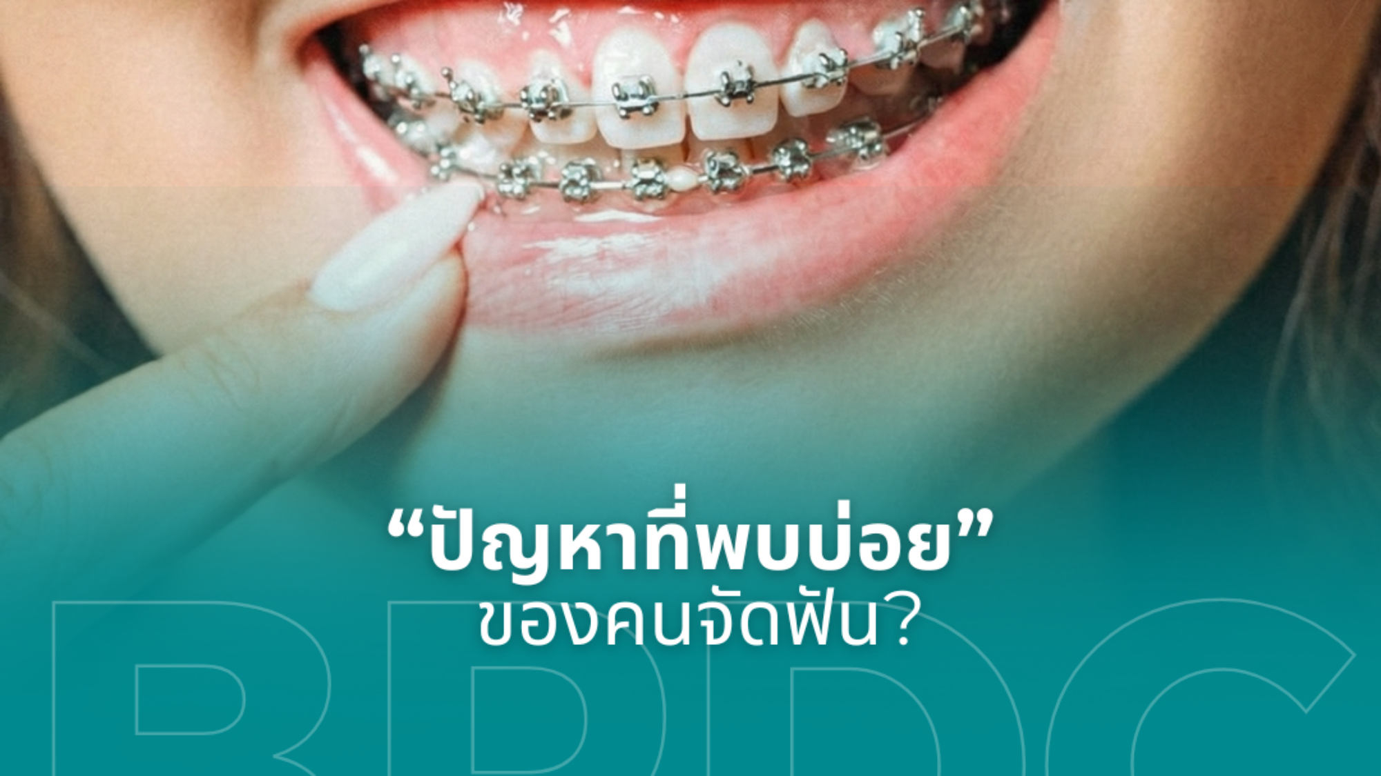 ปัญหาที่พบบ่อยของคนจัดฟัน
