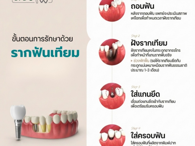 เจาะลึกขั้นตอนการรักษาด้วยรากฟันเทียม