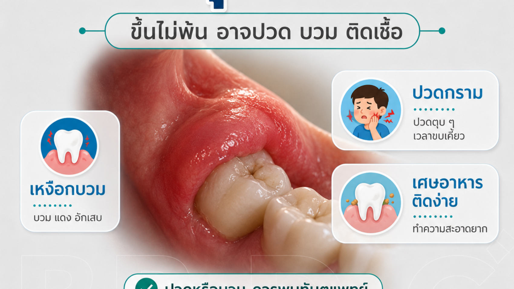 ฟันคุดอักเสบ ปวด บวม เคี้ยวลำบาก อย่าปล่อยไว้นาน