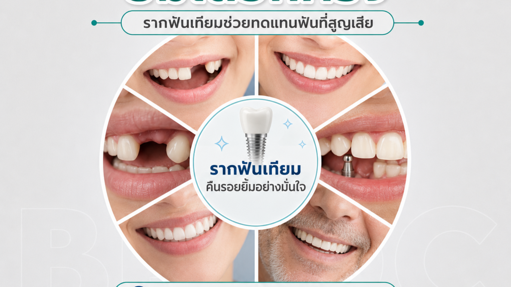 รู้จักรากฟันเทียม ฟันหายยิ้มได้อีกครั้ง